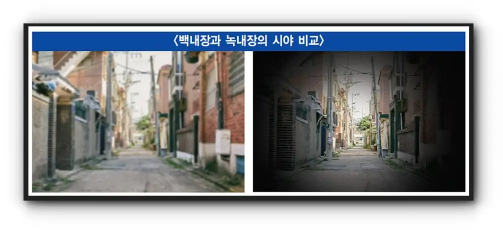 백내장과 녹내장 차이